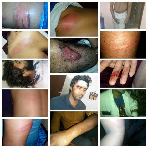 Injuries Sustained by Young Honda Workers on the Evening of 16th February after Police and Goons Assault Them